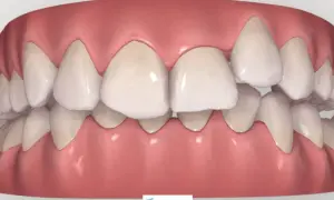 Arcata dentale con un dente storto in evidenza, che necessita di correzione ortodontica per un sorriso perfetto.