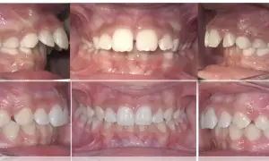 Denti sporgenti prima e dopo: vista laterale e frontale di un sorriso con denti allineati e corretti.