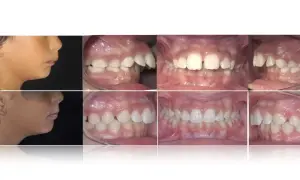Prima e dopo: correzione di denti a castoro e malocclusioni.