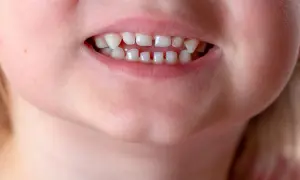 Primo piano di un sorriso di bambino con un diastema tra i denti inferiori, che mostra i denti da latte.