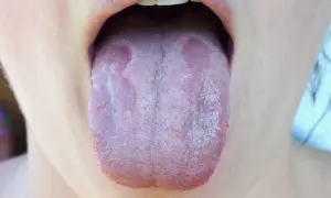 Lingua con placche biancastre, sintomo di candida orale. Si valuta l'uso di fermenti lattici per candida orale.