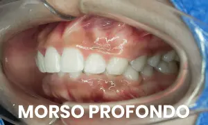 Denti bianchi e gengive rosa in un'apertura orale. Si nota un morso profondo, dove i denti superiori coprono quasi completamente quelli inferiori.