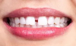 Labbra rosse e sorridenti rivelano un diastema tra i denti, uno spazio che rende unico il sorriso.