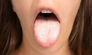 Lingua con patina biancastra e rossore, possibile sintomo di candida orale da stress.