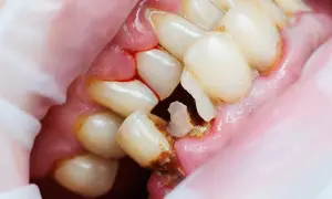 Denti con evidenti crepe e carie, gengive infiammate e sanguinanti. Un quadro preoccupante di salute orale.