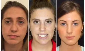Tre volti di donna mostrano una grave asimmetria facciale prima e dopo un trattamento estetico.