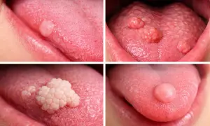 Varie protuberanze in fondo alla lingua, alcune singole e arrotondate, altre più grandi e a grappolo, mostrano diverse condizioni della lingua.