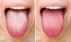 Confronto tra una lingua bianca e una lingua sana e rosa. La lingua gialla può indicare problemi di igiene o salute.