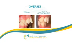 Prima e dopo ortodonzia: denti castoro corretti. Studio dentistico Annecchini - De Luca.