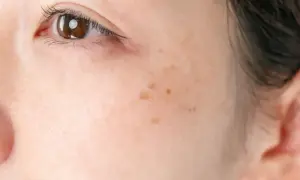 Primo piano del volto di una donna con una piccola macchia scura interno guancia, vicino all'occhio.