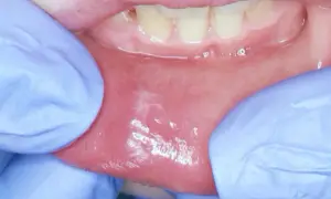 Dita guantate espongono la mucosa orale, rivelando una macchia bianca sul labbro inferiore, forse un segno di irritazione.