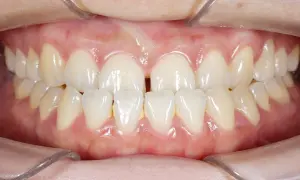 Denti superiori e inferiori di un adulto con un evidente morso incrociato. Si nota uno spazio tra gli incisivi superiori.