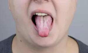 Lingua strana dopo antibiotico, con patina bianca e striature rosate.