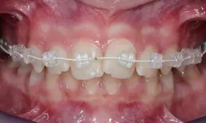 Primo piano di denti con apparecchio trasparente. Il filo bianco collega i bracket, mostrando il progresso del trattamento ortodontico e suggerendo ogni quanto si cambia il filo dell'apparecchio.