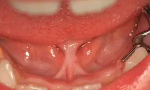 Vista ravvicinata della bocca, con la lingua in alto e il frenulo linguale normale che collega la lingua al pavimento della bocca.