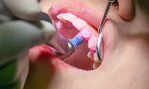 Dettaglio di una pulizia denti professionale con pasta lucidante rosa e uno strumento rotante.