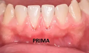 Gengive arrossate e gonfie, con segni di infiammazione, suggeriscono una stomatite gengivale. La parola "PRIMA" indica la situazione iniziale.