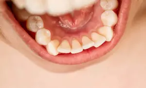 Denti ingialliti e con accumuli di tartaro, un rischio che fa cadere i denti.