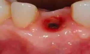 Cavità gengivale infiammata, forse un'alveolite, che mostra segni di guarigione.