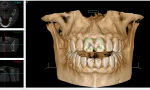 Vista 3D di denti con evidenziate aree di interesse. Si nota il canale naso palatino nelle sezioni assiale e coronale.