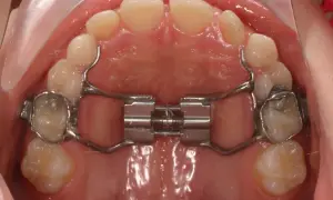Espansore palatino con bite block ortodonzia. Strumento metallico per allargare il palato, fissato ai denti.