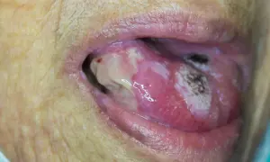 Lingua con lesioni biancastre e aree necrotiche, suggestive di carcinoma squamoso lingua.