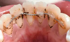 Denti con accumuli di placca e tartaro attorno a un retainer fisso.