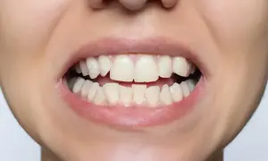 Primo piano di un sorriso con denti leggermente disallineati, che suggerisce la ricerca di malocclusione dentale rimedi.