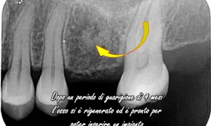 Radiografia dentale mostra rigenerazione ossea dopo displasia cemento ossea, pronta per impianto.