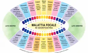 Schema sulla malattia focale in odontoiatria: denti devitalizzati, parodontite, amalgama e altri problemi legati ai **quadranti denti**.