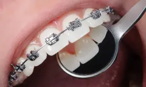 Dettaglio di denti con apparecchio ortodontico metallico. Un piccolo specchietto riflette i denti, mostrando come si mette l'apparecchio.