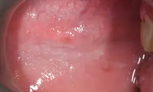 Guancia interna con area biancastra e lievemente rialzata, sospetto fibroma.