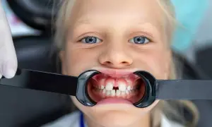 Bambina con diastema, uno spazio tra i denti. Non tentare di chiudere lo spazio tra i denti fai da te, consulta un dentista.