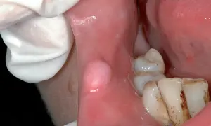Guancia interna con gonfiore, forse dovuto a un morso. Denti visibili.