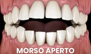Denti con morso aperto. Si può mettere l'apparecchio anche avendo degli impianti dentali per correggere questa malocclusione.