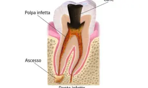 Dente infetto con carie e polpa infetta. Si nota un ascesso alla radice, segno di un'infezione avanzata.
