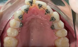 Apparecchio linguale: recensioni positive per questo trattamento ortodontico discreto.