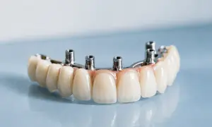 Protesi dentale fissa con denti staccati, fissata su pilastri metallici.