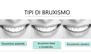 Tre immagini di sorrisi mostrano diversi gradi di bruxismo: assente, lieve/moderato e severo.