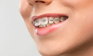 Sorriso con apparecchio ortodontico per correggere una malocclusione mandibolare. Denti allineati e labbra lucide.