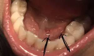 Vista ravvicinata della bocca, con due frecce nere che indicano una piccola pallina bianca sotto la lingua, vicino ai denti posteriori.
