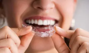 Dettaglio di una persona che tiene una mascherina trasparente, mostrando la differenza tra bite e mascherina per l'allineamento dentale.