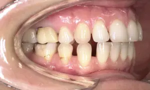 Denti con evidente overjet e overbite, alcuni incisivi superiori coprono quasi completamente quelli inferiori.
