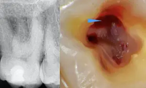 Radiografia e ingrandimento del primo molare superiore con polpa esposta e sanguinante, indicata da una freccia blu.