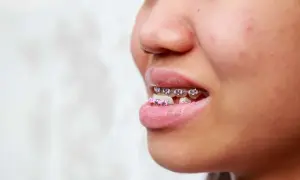 Primo piano di un sorriso con apparecchio ortodontico, inclusi brackets rosa, per correggere un morso inverso.