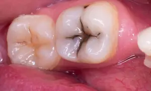 Dente con carie occlusale, un'area scura e profonda nella fessura del dente, che necessita di cure dentali.