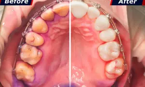 Prima e dopo: la differenza tra placca e tartaro è evidente. I denti appaiono più puliti e sani dopo il trattamento.