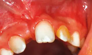 Dettaglio degli incisivi centrali superiori con gengive rosse e infiammate. Si notano macchie bianche sullo smalto.