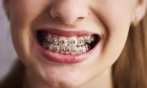 Sorriso di una persona con apparecchio denti. I denti sono allineati con brackets metallici e fili.