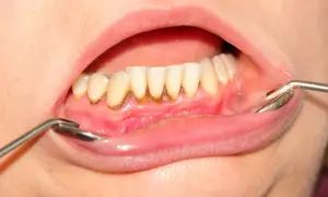 Denti con accumulo di tartaro visibile alla base, evidenziato da uno specchietto dentale.